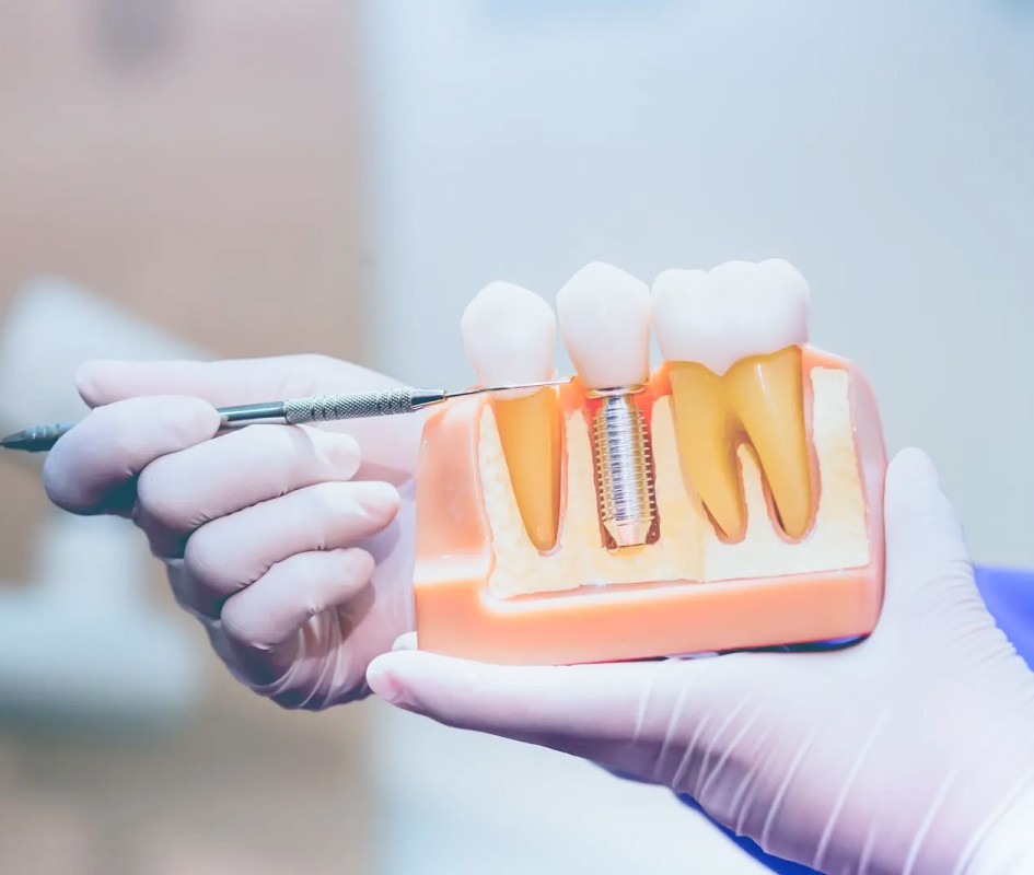 Drs Christian Maire et Zacharie Lang implants dentaires